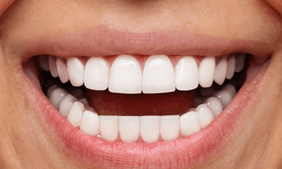 Porcelain-Veneers-After-Image