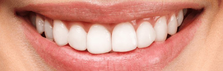 Teeth-Whitening-After-Image