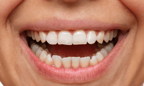 Porcelain-Veneers-Before-Image
